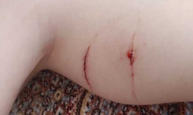 حمله سگ‌ هار به پسر ۱۲ ساله در مرکز شهر تبریز